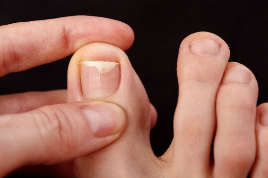 Closeup Of Toe Skin. Nail Detachment, Fungal Nail Infections, Onycholysis, Dermatologist, Therapeutic Pedicure, Examination Toenail, Skin. Careful Inspection Of Toe Skin And Nails, Closeup Macro shot
