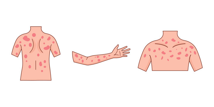 Measles Virus Skin Symptoms Medical Illustration with Red Skin Rash on Torso and Arm.