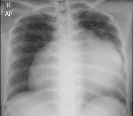 chest x-ray image of cardiomegaly&nbsp;