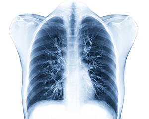 X Ray of man chest against white background 