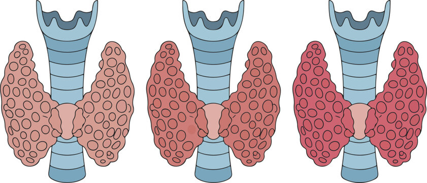 A medical illustration showing three identical simplified diagrams of human thyroids in a row.