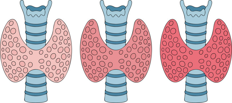 A medical illustration showing three identical simplified diagrams of human thyroids in a row.