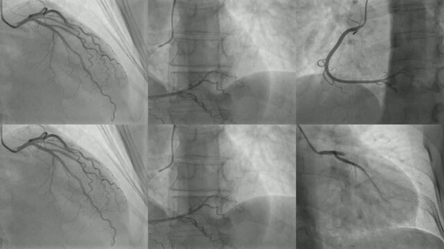 Normal Coronary Left and Right Angiogram views 
