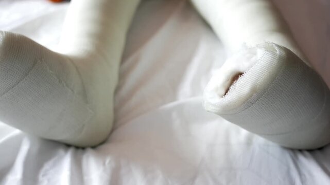 Legs in white orthopedic casts resting on bed with patient moving toes in motion