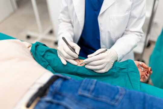 Close-up of doctor removing mole from patient arm with surgical tweezers and scalpel. Dermatology procedure, biopsy and minor surgery concept. Professional physician performing skin treatment.