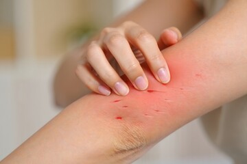 Close-up of irritated skin on arm with scratches and redness.