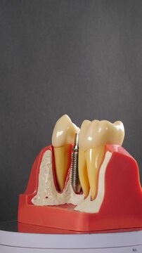 Missing teeth replacement. Dental implant installation. Jaw model with dental implant. Dentist places crown on dental implant. implant crown. Dentist shows dental crown installation. Vertical video