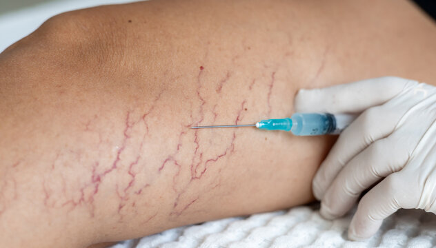Sclerotherapy procedure for spider veins on female leg. varicose capillary network treatment close up
