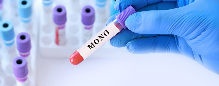 Doctor holding blood sample tube with MONO test, monocyte count analysis explaining immune response, inflammation, infection detection for blood disorders diagnosis,complete blood count interpretation