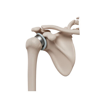 A medical illustration of a shoulder joint with a metal prosthetic