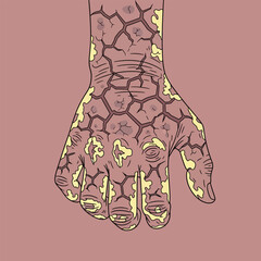 Severe Hand Dermatitis Medical Illustration