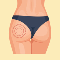 Fractional Laser Treatment Marks on Woman Buttocks
