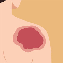 Severe Skin Burn or Inflammation on Shoulder Illustration