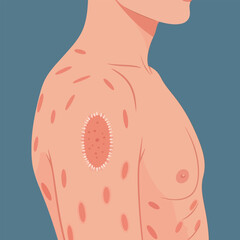 Pityriasis Rosea Skin Rash Medical Illustration