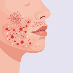 Dermatological Symptoms of Rosacea and Acne on Face