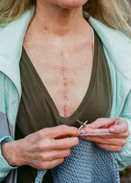 Woman with Heart Surgery Scar
