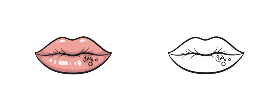 Human lips with cold sore herpes virus in colored and line art styles showing skin infection on white background representing dermatology and medical condition