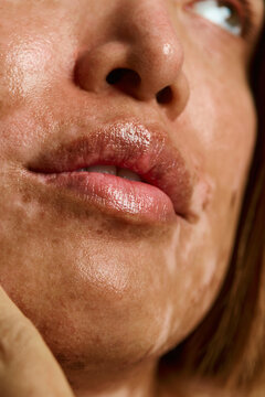 Close-up lips and chin of person with vitiligo