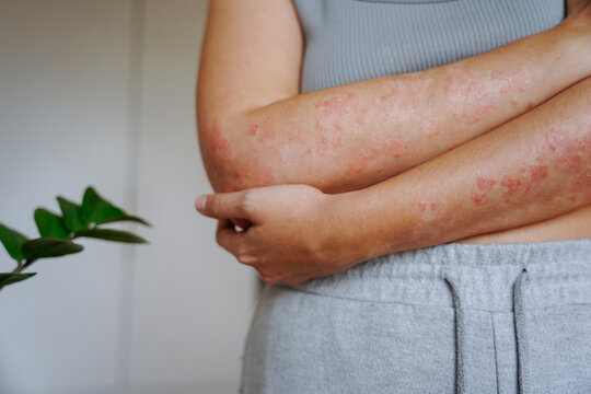 Woman with psoriasis