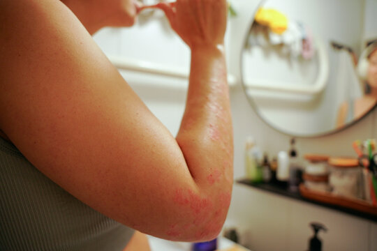 Woman with psoriasis