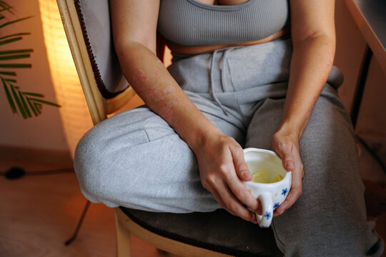 Woman with psoriasis