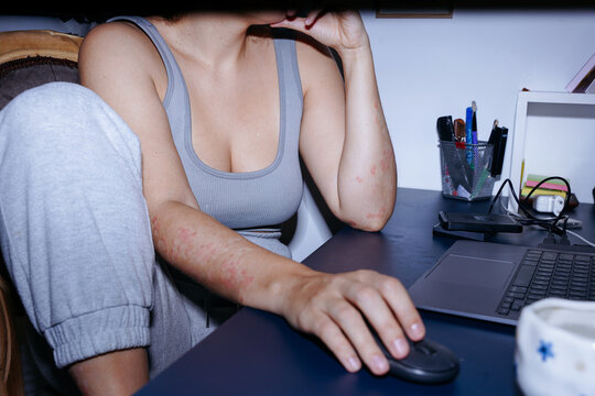 Woman with psoriasis