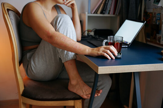 Woman with psoriasis