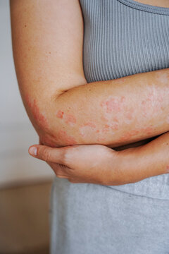 Woman with psoriasis