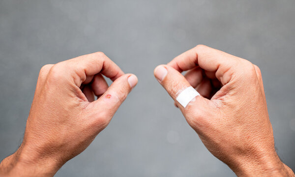 Wounded hands