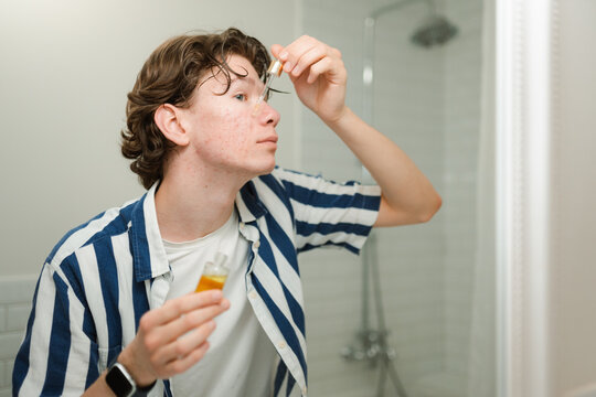 Self-treatment of acne