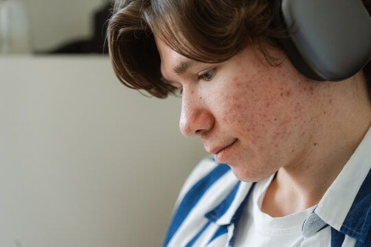 Portrait of a man with acne wearing headphones