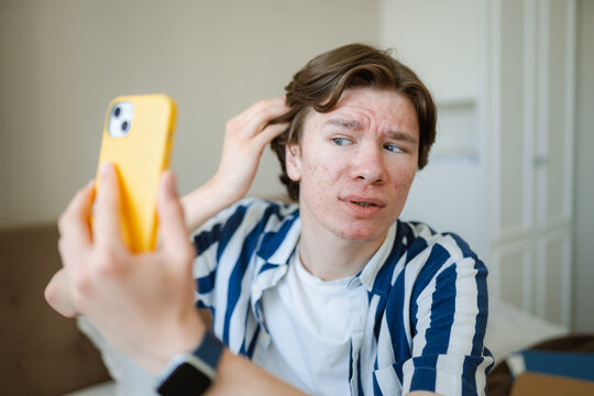 A man with acne takes selfie on a mobile phone