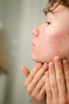 Self-treatment of acne