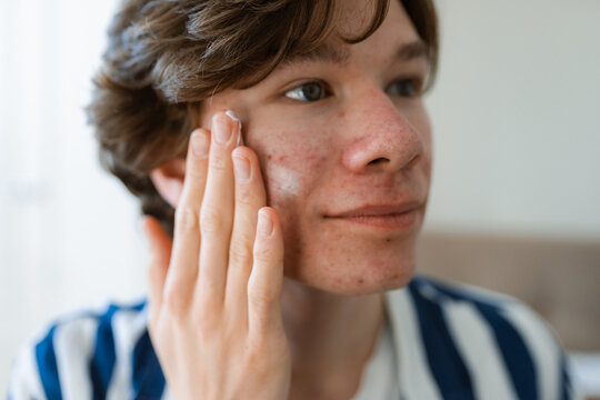Self-treatment of acne