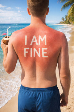 Man with sunburned back saying IAMFINE on beach with coconut drink sunburnt