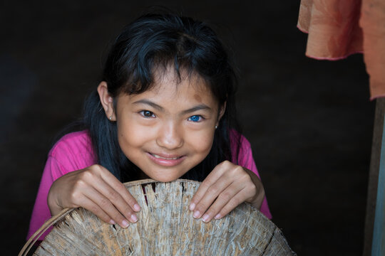 Girl with one blue eye and one normal color eye in Dak Lak, Viet