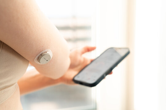 MINSK, BELARUS - FEBRUARY 21, 2026: Female uses the Dexcom ONE+ Continuous Glucose Monitoring (CGM) system sensor on her arm, syncing real-time blood sugar data with a smartphone app for modern diabet