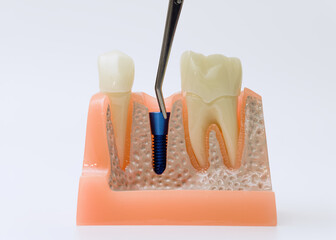 Dental implant model with tool pointing at titanium screw © Maximusdn