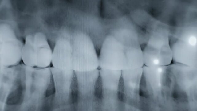 Dental panoramic X-ray image showcases a full arch of teeth in shades of gray, bones visible