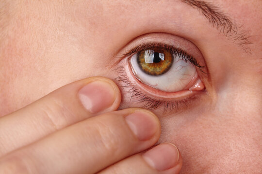 Macro Eye. Woman checking eyeball. Beautiful woman pulls her lower eyelid down to reveal the whites of the eye. Checking for foreign bodies and signs of illness. Optician, Ophthalmology Clinic