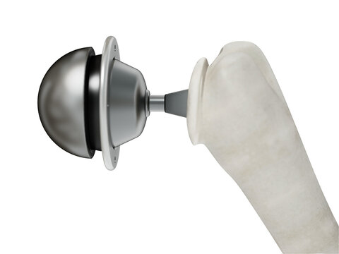 3D illustration of shoulder replacement surgery on transparent background. 3D illustration