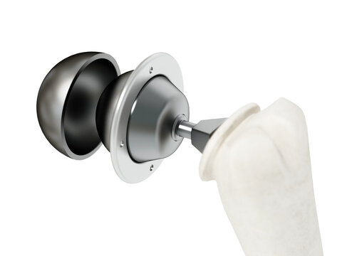 3D illustration of shoulder replacement surgery on transparent background. 3D illustration