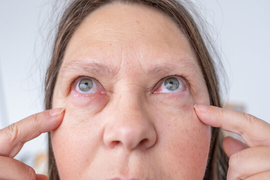 female eye with visible redness, severe swelling, Clinical observation periorbital edema, inflammatory process, allergic or infectious eye condition, ocular inflammation and trauma, blepharitis