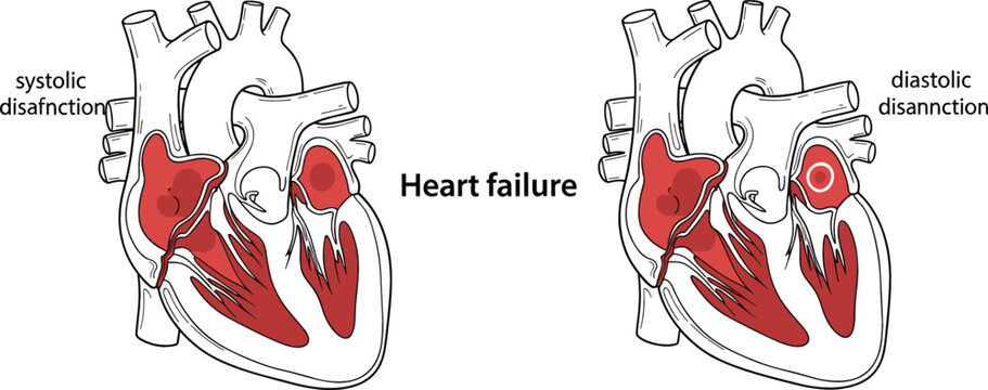 Medical illustration of heart failure showing cross section of human heart with systolic dysfunction and diastolic dysfunction comparison diagram