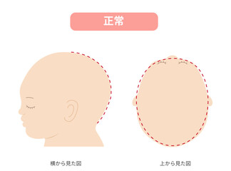 横と真上から見た頭の形が正常な赤ちゃんのイラスト　斜頭症,短頭症,長頭症との比較
