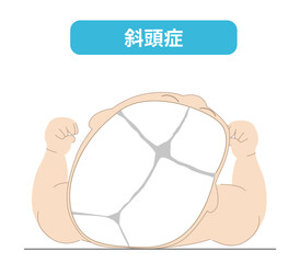 赤ちゃんが寝ている頭の向きによって頭の形に歪みが生じるメカニズム、斜頭症,短頭症,長頭症の赤ちゃんのイラスト