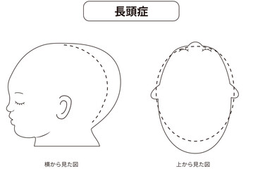 白黒線画　横と真上から見た頭の形に歪みがある斜頭症,短頭症,長頭症の赤ちゃんのイラスト