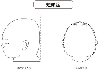 白黒線画　横と真上から見た頭の形に歪みがある斜頭症,短頭症,長頭症の赤ちゃんのイラスト