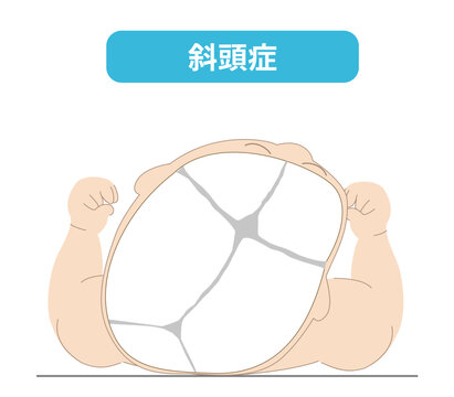 赤ちゃんが寝ている頭の向きによって頭の形に歪みが生じるメカニズム、斜頭症,短頭症,長頭症の赤ちゃんのイラスト