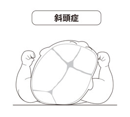 赤ちゃんが寝ている頭の向きによって頭の形に歪みが生じるメカニズム、斜頭症,短頭症,長頭症の赤ちゃんのイラスト